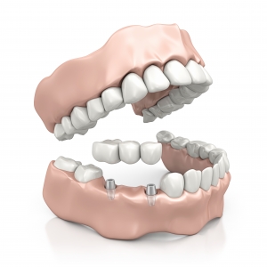 Zahnverlust? Wackelige Prothese? Dr. Eric Noack M.Sc. in Göttingen hat über 4.000 Mal ein Zahnimplantat gesetzt. Implantatsprechstunde. Implantolgie. Zahnersatz. Feste Zähne. Zahn verloren.